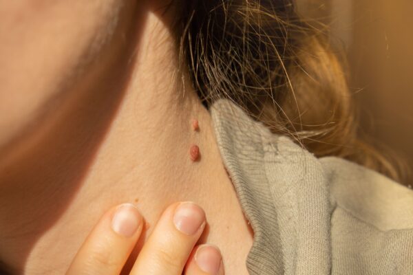 How Do I Stop Skin Tags From Growing Again