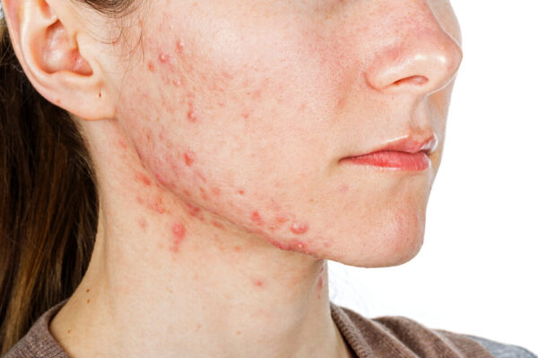 How Does Pimples Treatment Work for Teens? How Does Pimples Treatment Work for Teens