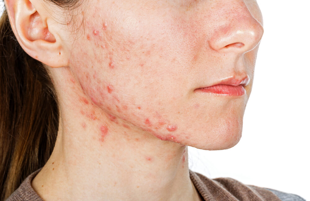 How Does Pimples Treatment Work for Teens