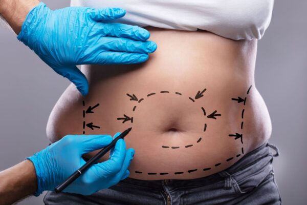 How Does Tummy Tuck Treatment Work