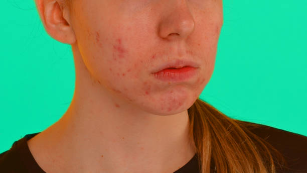 How Is Laser Acne Treatment Done Safely?