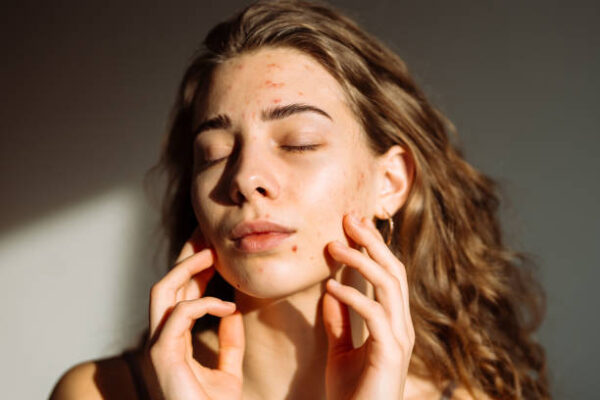 How Is Laser Acne Treatment Done Safely?