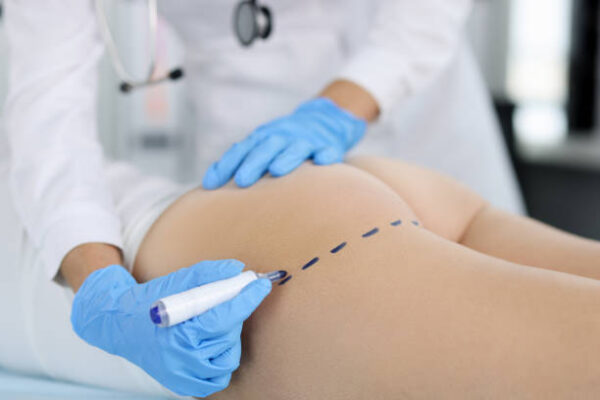 How Long Does Brazilian Butt Lift Surgery Last? How Long Does Brazilian Butt Lift Surgery Last?
