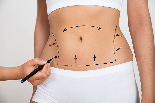 How Much Fat Can Liposuction Remove