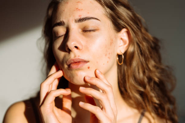 Is Acne Scar Treatment Permanent