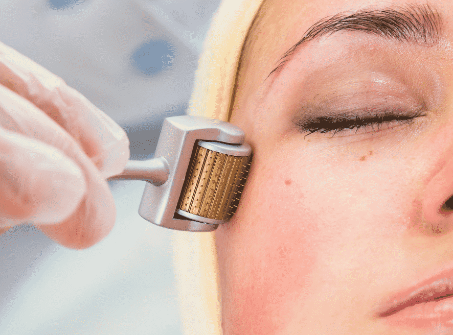 Is Derma Rollers Treatment Effective for Acne Scars