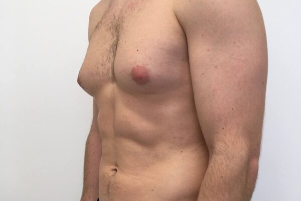 Is Gynecomastia Surgery Painful or Painless?