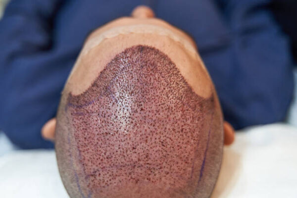 Is Hair Transplant Safe and Reliable for Thinning Hair?