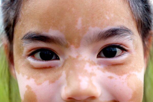 Is Vitiligo Treatment Suitable for Children?
