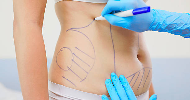 Mini Abdominoplasty Surgery: Real Results Revealed
