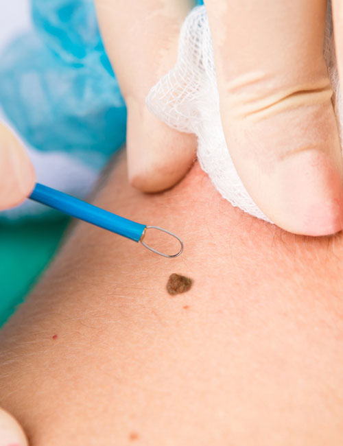 Can You Remove Multiple Moles In One Session?