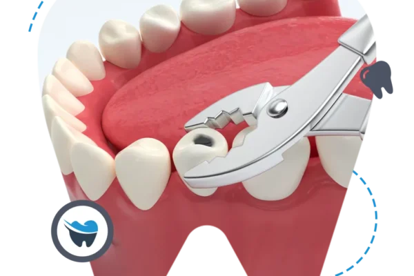 wisdom teeth extraction perth