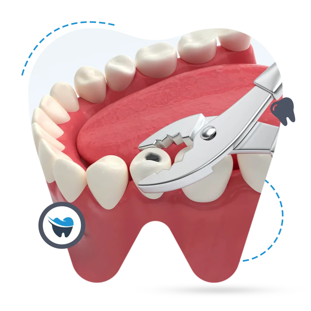 wisdom teeth extraction perth