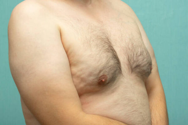 What Age Is Ideal for Gynecomastia Surgery