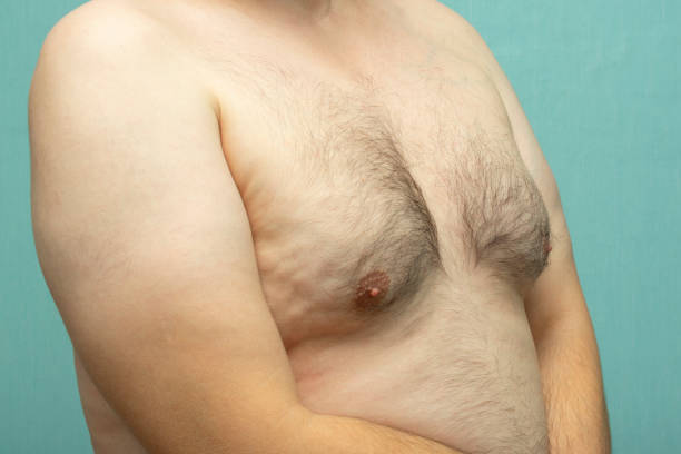 What Age Is Ideal for Gynecomastia Surgery