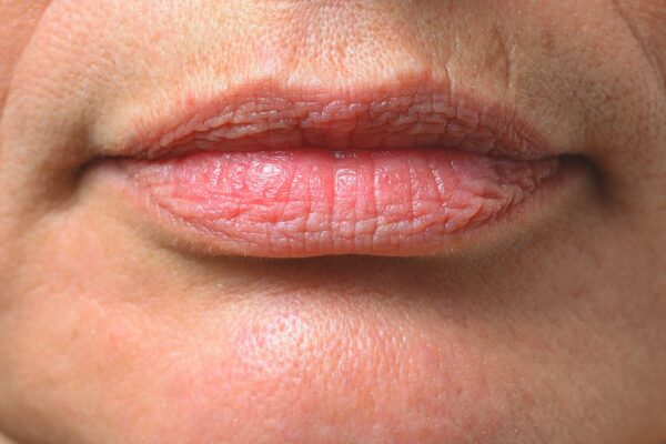 What Is Smoker’s Lips Treatment and How Does It Work? What Is Smoker’s Lips Treatment and How Does It Work