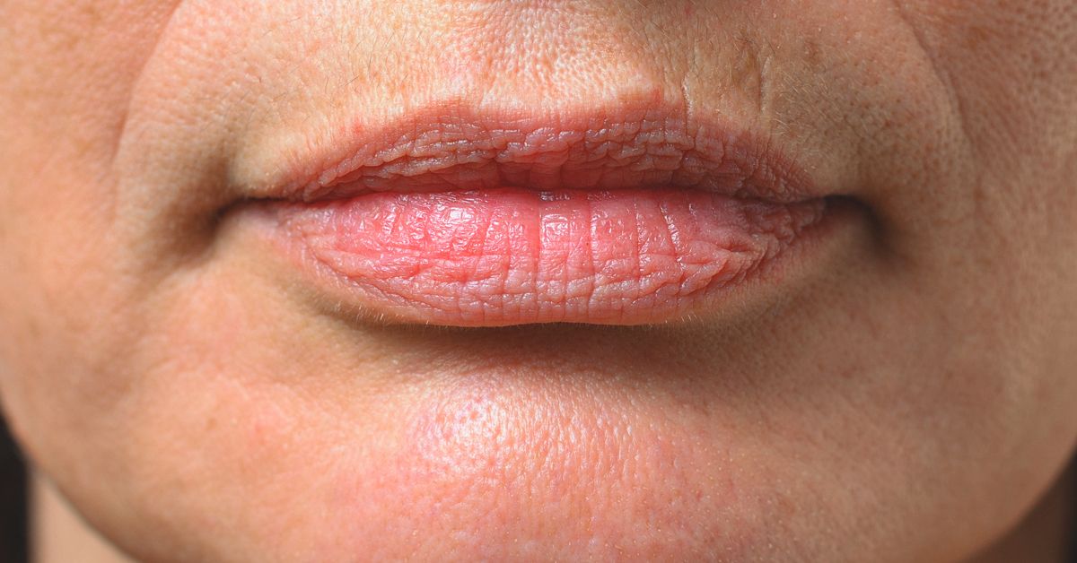 What Is Smoker’s Lips Treatment and How Does It Work