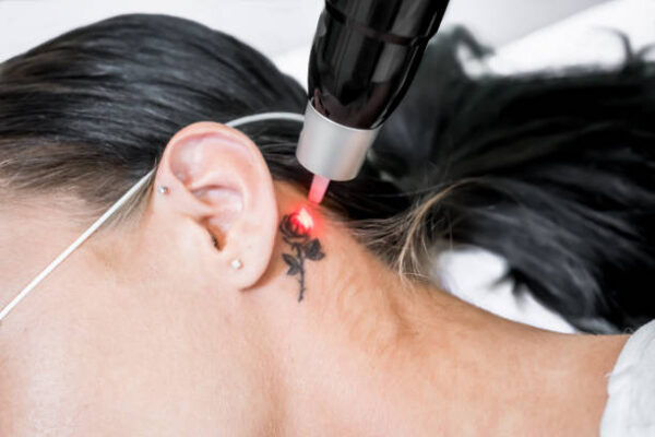 What Makes Laser Tattoo Removal Popular?