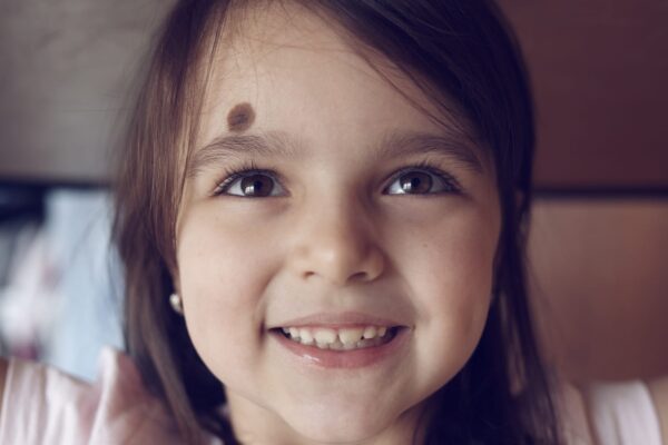 Is Birthmark Removal Treatment Safe for Children? Is Birthmark Removal Treatment Safe for Children?