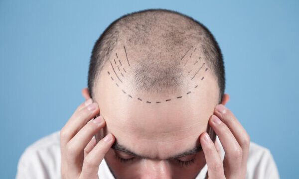 hair transplant clinic in ahmedabad, hair transplant clinic, hair transplant, Ahmedabad, hair transplant services