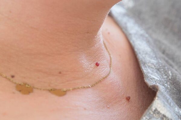 Can You Permanently Get Rid Of Skin Tags On Skin?