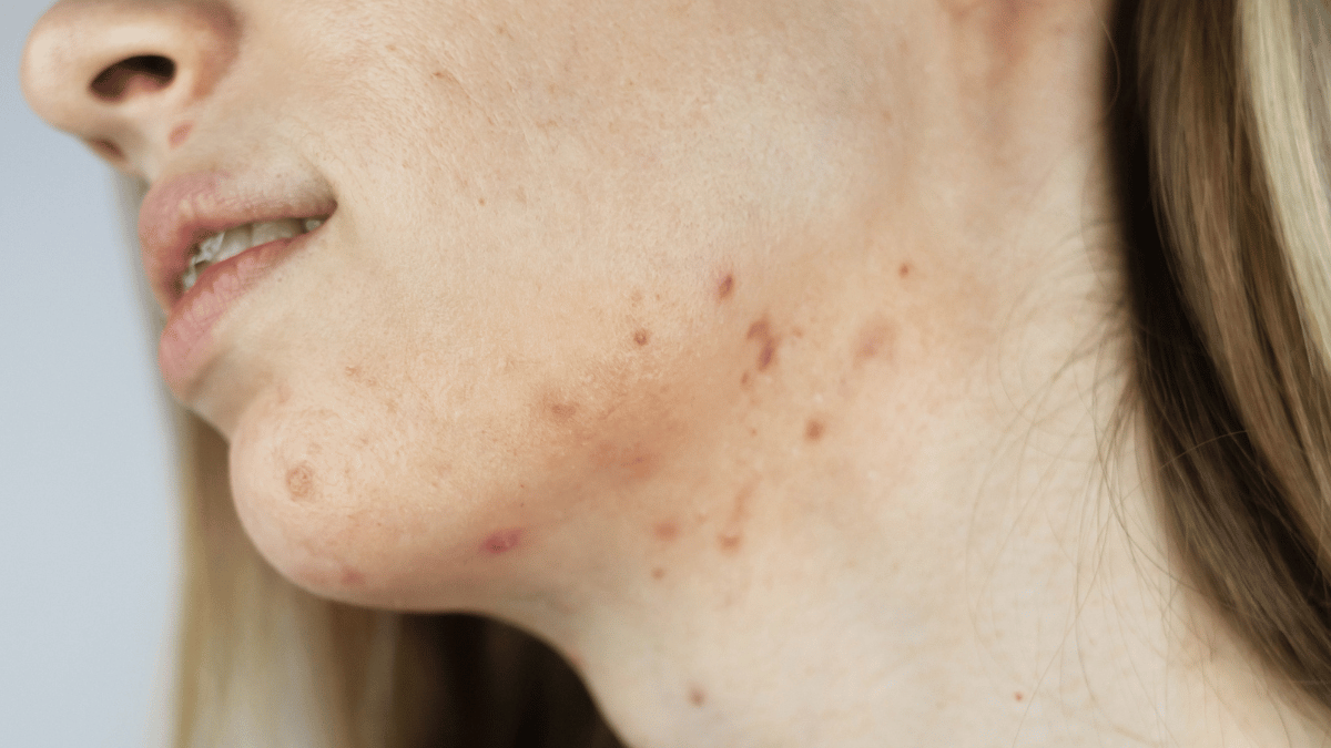 Does Acne Treatment Work on Hormonal Breakouts?