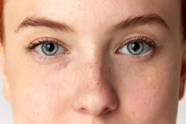 Does Eye Bag Removal Give Permanent Results