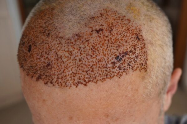 Does Hair Transplant Cost Depend on Hair Density?