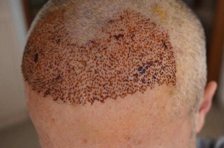 Does Hair Transplant Cost Depend on Hair Density?