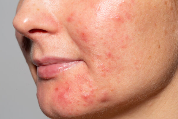 Does Pimples Treatment Require Multiple Sessions