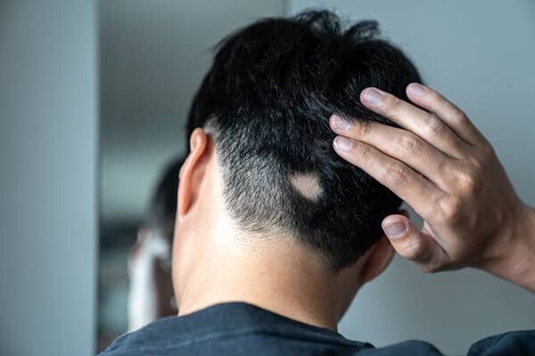 How Alopecia Areata Treatment Boosts Confidence Levels ? How Alopecia Areata Treatment Boosts Confidence Levels