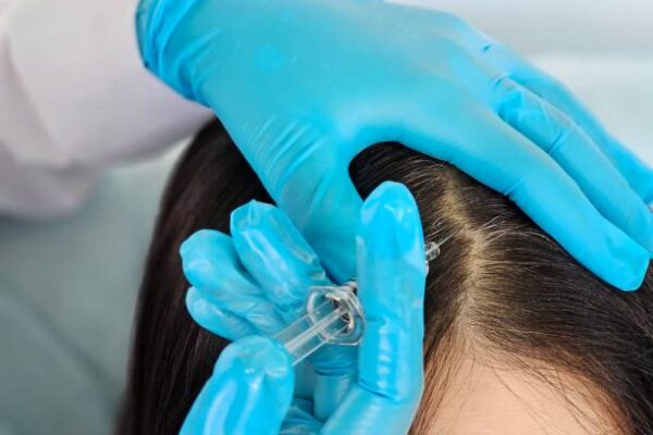 How Effective Is Hair PRP for Hair Loss