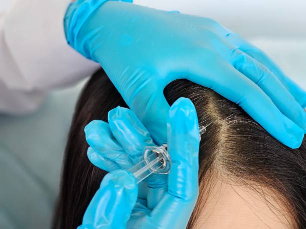 How Effective Is Hair PRP for Hair Loss