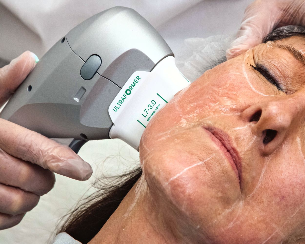 How HIFU Treatment Works for Cheek and Jaw Lift