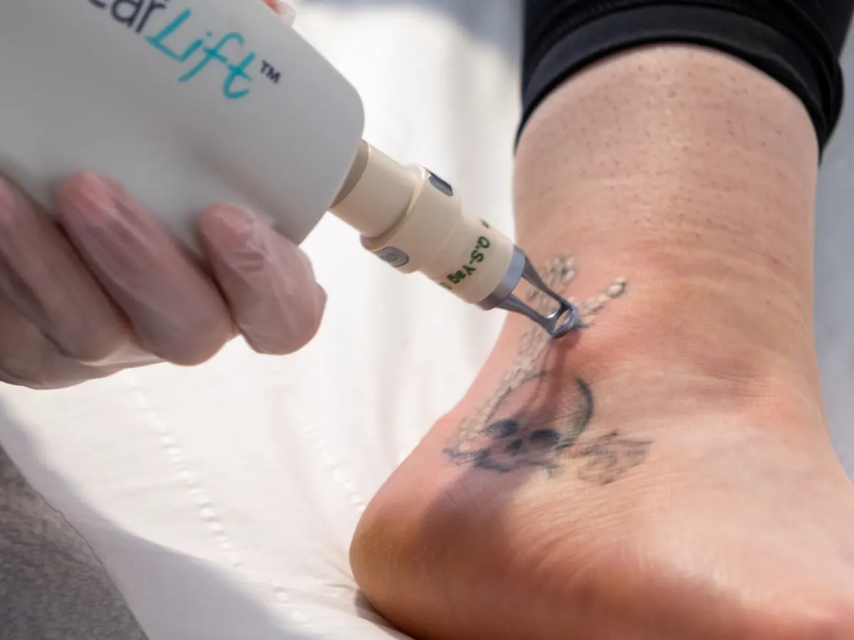 How Laser Tattoo Removal Technology Has Advanced