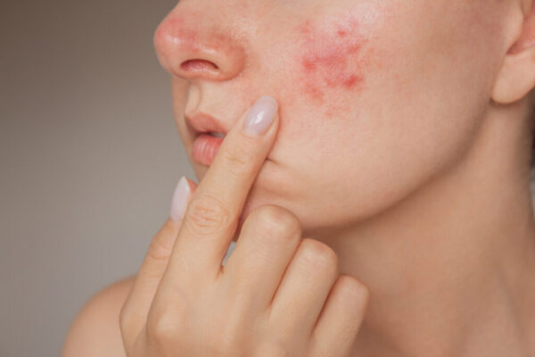 How Pimples Treatment Transforms Skin How Pimples Treatment Transforms Skin