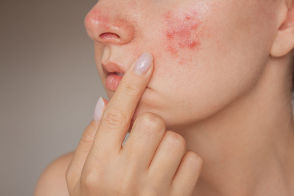 How Pimples Treatment Transforms Skin