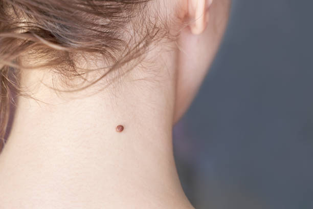 How Warts Removal Treatment Restores Skin Confidence