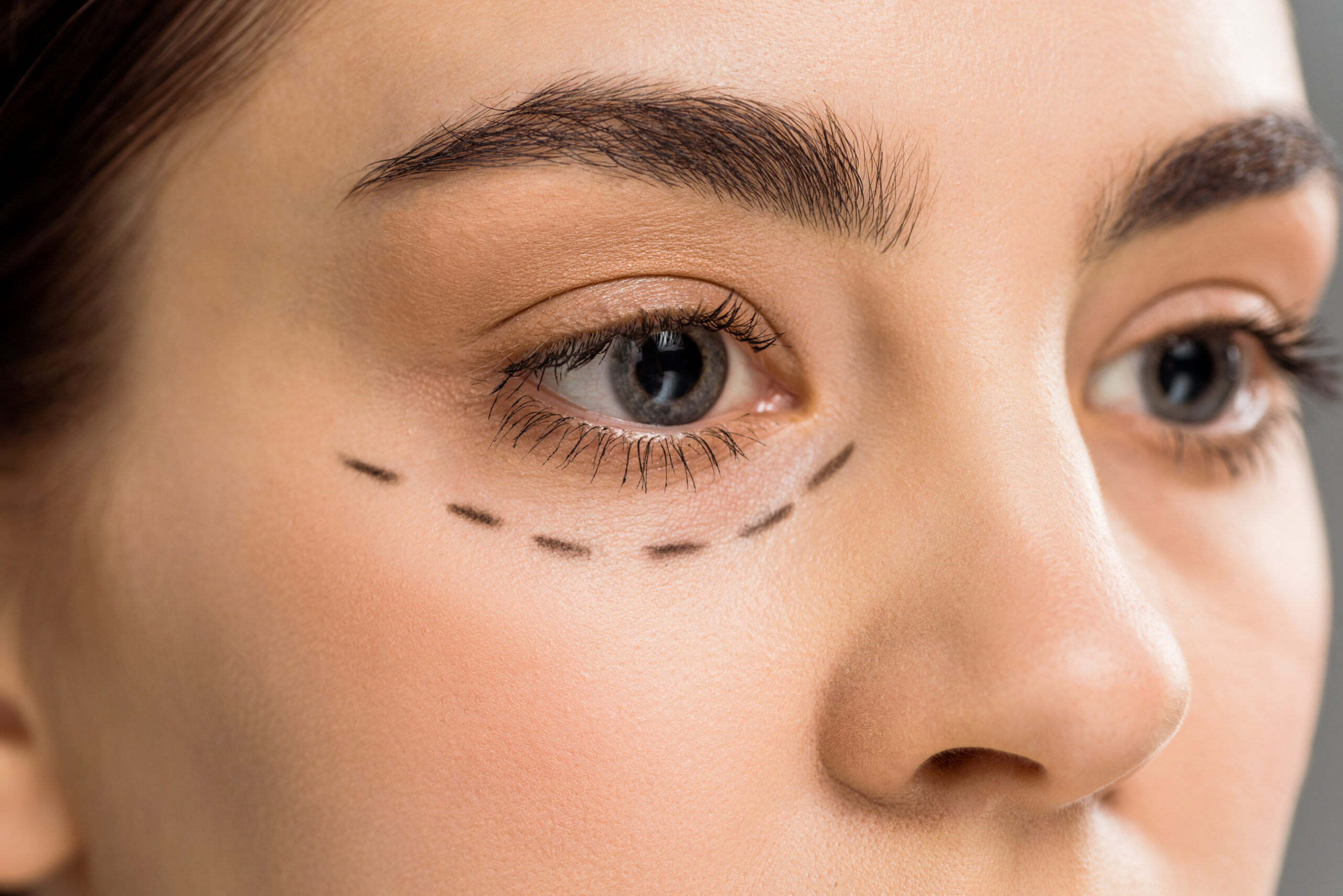 Is Eyelid Surgery the Right Choice for You?