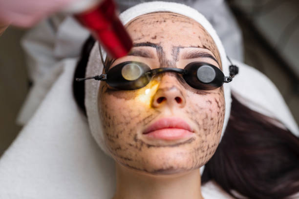 Is Laser Carbon Peel Good for Enlarged Pores