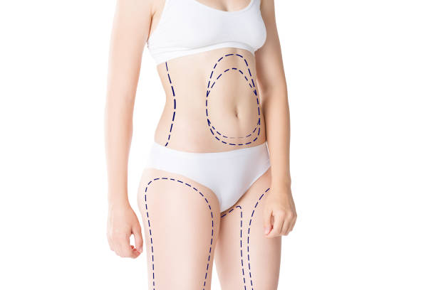 What Areas Can Liposuction Target