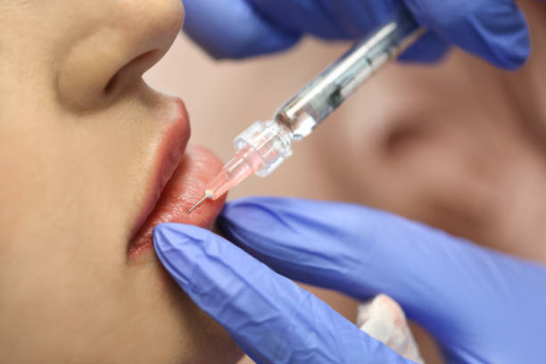 What’s the Right Age to Start Lip Fillers Enhancements