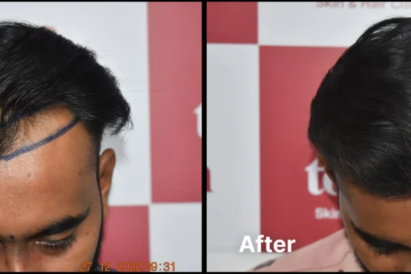 How To Find The Best Hair Transplant Clinic In Ahmedabad? hair transplant calinic