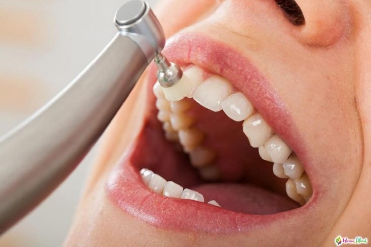 teeth cleaning