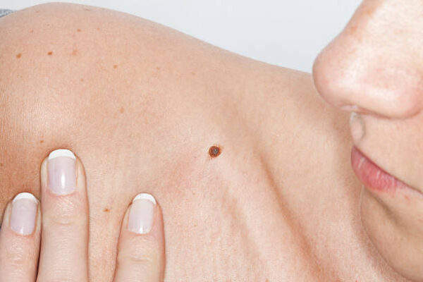 Can Benign Mole Removal Treatment Leave No Scars Behind