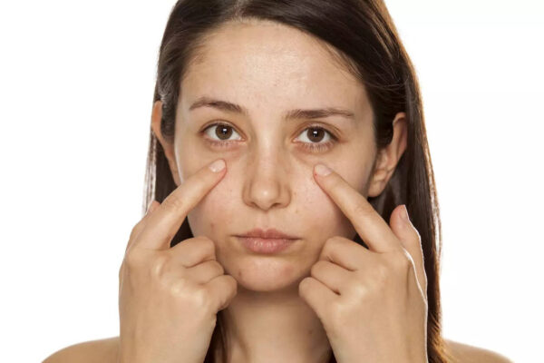 Can Dark Circles Treatment Fix Hereditary Eye Bags