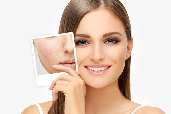 Can Laser Acne Scar Treatment Remove Old Stubborn Scars