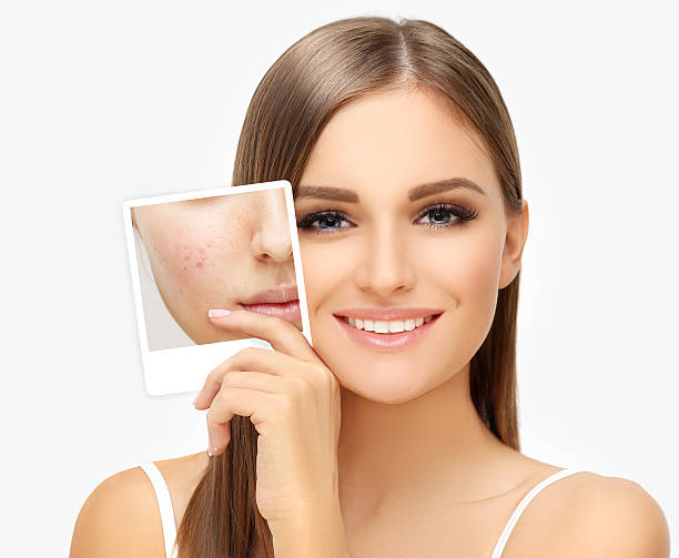 Can Laser Acne Scar Treatment Remove Old Stubborn Scars