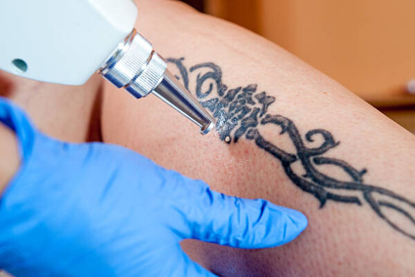 Can Laser Tattoo Removal Erase Dark Ink Tattoos