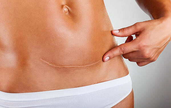 Can Surgical Scar Revision Remove Deep Facial Scars